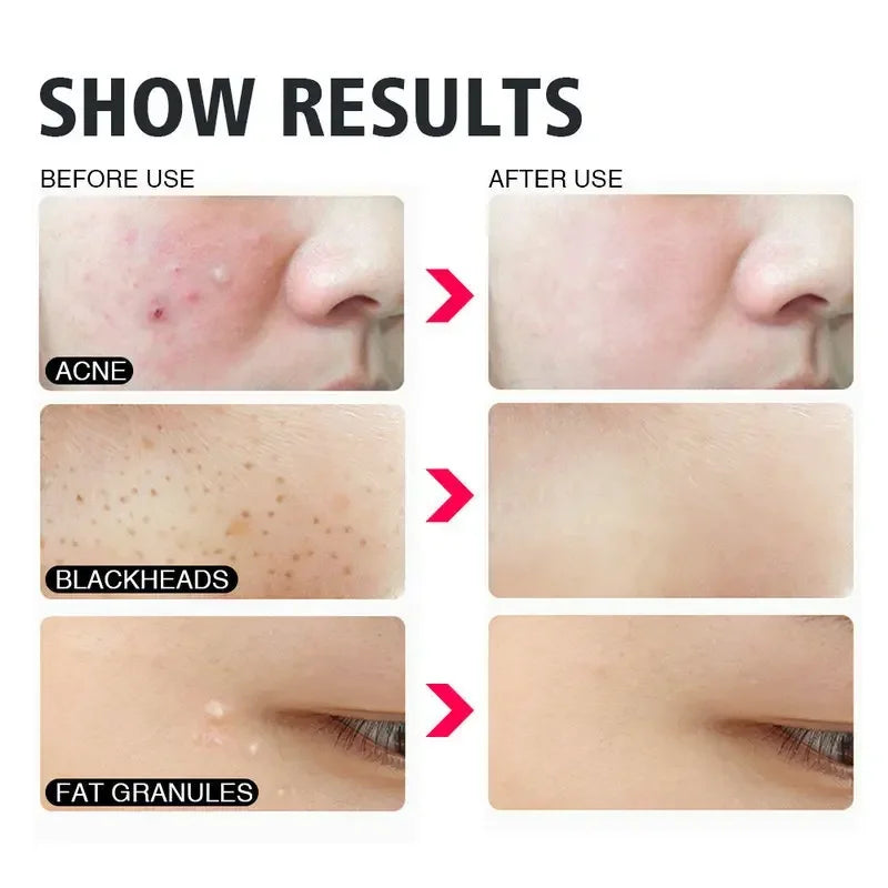 Spot Blemish Remover Skin Care